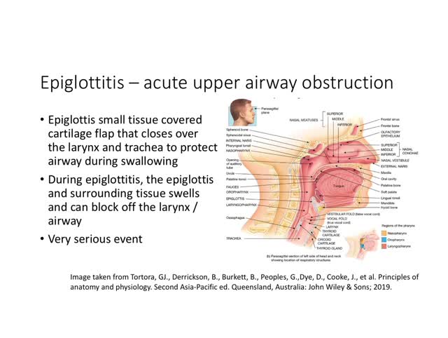 Childrens respiratory conditions 3 Epiglottitis