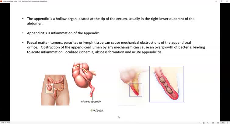 Acute appendicitis